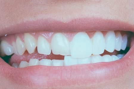 ilustraLentesContato_A