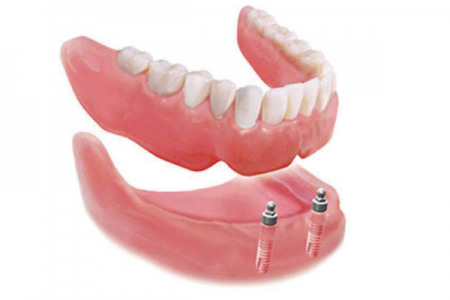 overdenture total